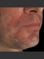 Before Photo Infini Acne Scar Treatment #13 - Prejuvenation Before & After