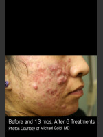 Before Photo Treatment of Cystic Acne #302 - Prejuvenation Before & After