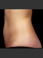 After Photo SculpSure Abdomen - Prejuvenation Before & After