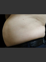 Before Photo Body Contouring Treatment #116 - Prejuvenation Before & After
