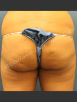 Before Photo Fat Transfer to Buttocks - Prejuvenation Before & After
