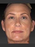 After Photo Sun Damage Reduction - Prejuvenation Before & After