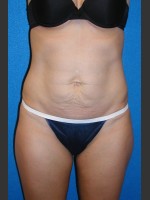 Before Photo Tummy Tuck Case #2 - Prejuvenation Before & After