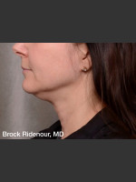 Before Photo ThermiTight Treatment - Prejuvenation Before & After