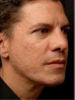 After Photo Infini Acne Scar Treatment - Prejuvenation Before & After
