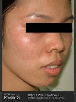 After Photo Before and After Revlite SI Series of Treatments for Melasma - Prejuvenation Before & After