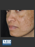 Before Photo Melasma Face Treatment 117 - Prejuvenation Before & After