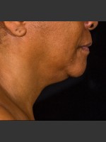 Before Photo SculpSure Submental - Prejuvenation Before & After