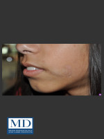 After Photo Birthmark Cafe Au Lait Macule Treatment 112 - Prejuvenation Before & After