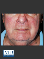 After Photo Rosacea Treatment 102 - Prejuvenation Before & After