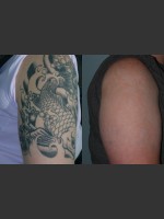 Before Photo Tattoo Removal - Prejuvenation Before & After