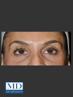Before Photo Midfacial Filler 136 - Prejuvenation Before & After