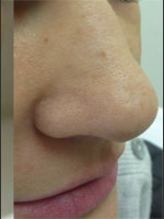 After Photo Treatment of Nose Acne Scar - Prejuvenation Before & After