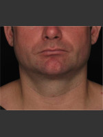 After Photo Treatment of Neck with Laser Liposuction - Prejuvenation Before & After
