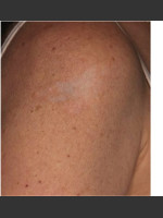 After Photo Treatment of Shoulder Tattoo - Prejuvenation Before & After