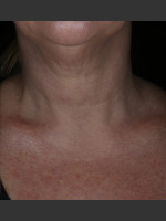 After Photo Alastin Skincare Restorative Neck Complex with TriHex Technology® - Prejuvenation Before & After