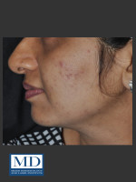 Before Photo Post Inflammatory Hyperpigmentation 120 - Prejuvenation Before & After