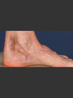 Before Photo Treatment of Pigmented Lesion on Foot - Prejuvenation Before & After