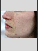 Before Photo Sublative Rejuvenation Treatment - Prejuvenation Before & After