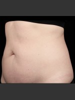 Before Photo SculpSure Abdomen - Prejuvenation Before & After