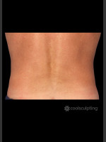 After Photo CoolSculpting on Man Flanks (Love Handles) - Prejuvenation Before & After