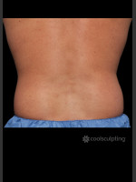 Before Photo CoolSculpting Before & After on Man - Prejuvenation Before & After