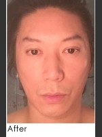 After Photo Sculptra for Male Facial Rejuvenation - Prejuvenation Before & After