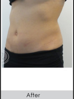 After Photo CoolSculpting+ Abdomen Treatment - Prejuvenation Before & After