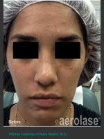 Before Photo NeoClear by Aerolase Acne Treatment - Prejuvenation Before & After