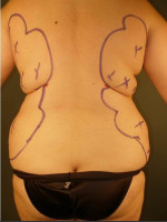 Before Photo Liposuction #44 Back View - Prejuvenation Before & After