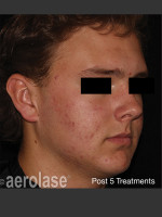 After Photo NeoClear by Aerolase Acne Treatment - Prejuvenation Before & After