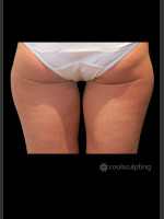 Before Photo CoolSculpting Before & After on Woman - Prejuvenation Before & After