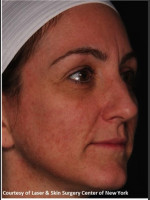 After Photo Full face Treament with Fraxel - Prejuvenation Before & After