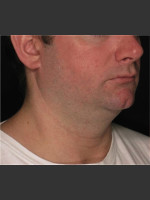 Before Photo Treatment of Neck with Laser Liposuction - Prejuvenation Before & After