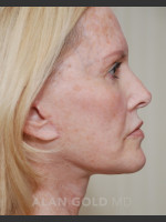 After Photo Rhytidectomy (Facelift) 1753 Side View - Prejuvenation Before & After
