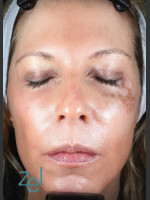 Before Photo Treatment of Left Side Hyperpigmentation - Prejuvenation Before & After