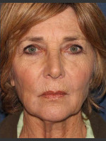 After Photo Facial Volumization - Prejuvenation Before & After