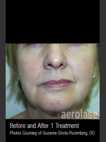 After Photo Skin Tightening #342 - Prejuvenation Before & After
