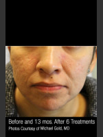 After Photo Treatment of Cystic Acne #300 - Prejuvenation Before & After