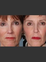 Before Photo Single treatment of fully ablative  Laser Resurfacing - Prejuvenation Before & After