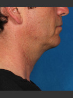 After Photo Kybella Treatment 47 Year Old Male - Prejuvenation Before & After