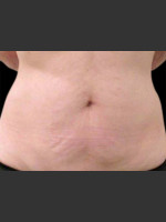 After Photo Body Contouring Treatment #114 - Prejuvenation Before & After