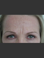 Before Photo Serene Procedure (Nuebelle) - Prejuvenation Before & After