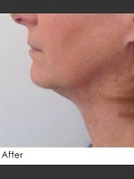 After Photo Kybella and Filler for Jawline Definition  - Prejuvenation Before & After