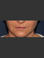 Before Photo Lip Augmentation - Prejuvenation Before & After
