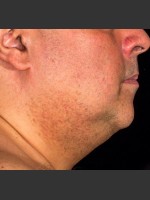 After Photo SculpSure Submental - Prejuvenation Before & After