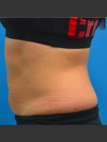 After Photo SculpSure Abdomen - Prejuvenation Before & After