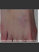 After Photo Treatment of Foot Tattoo - Prejuvenation Before & After