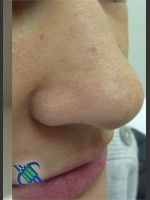 After Photo Treatment of Nose Acne Scar - Prejuvenation Before & After