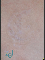 After Photo Treatment of Symbol Tattoo - Prejuvenation Before & After